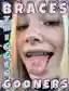 Braces triggers gooners (perverts) - Image 1